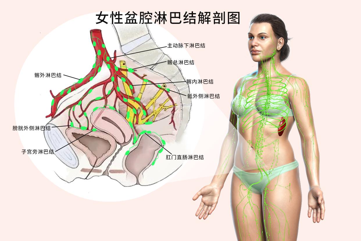 女性盆腔淋巴结解剖图 女性盆腔淋巴包括哪几组