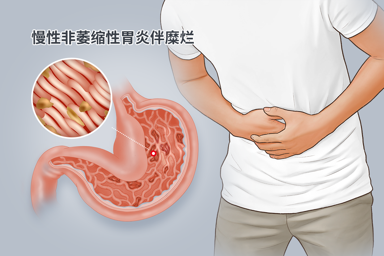 慢性非萎缩性胃炎伴糜烂图片（慢性非萎缩性胃炎伴糜烂严重吗会癌变吗）