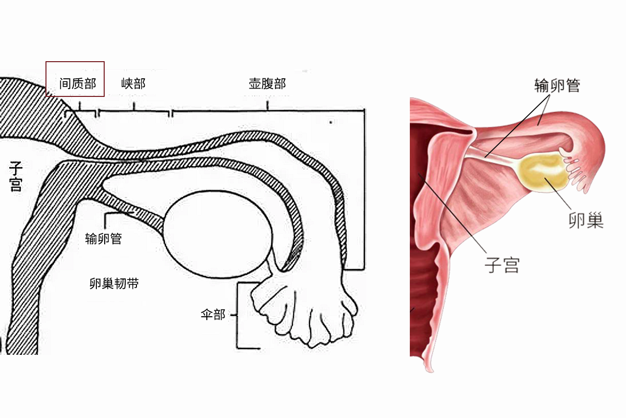 输卵管间质部图片（输卵管间质部是哪里?有图示吗?）