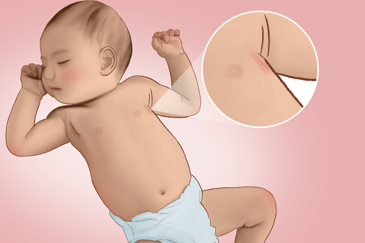 宝宝心脏手术疤痕图片（婴儿心脏手术疤痕能消除掉吗）