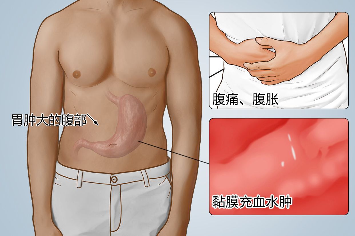 胃肿大的腹部图片（胃肿大的腹部图片高清）