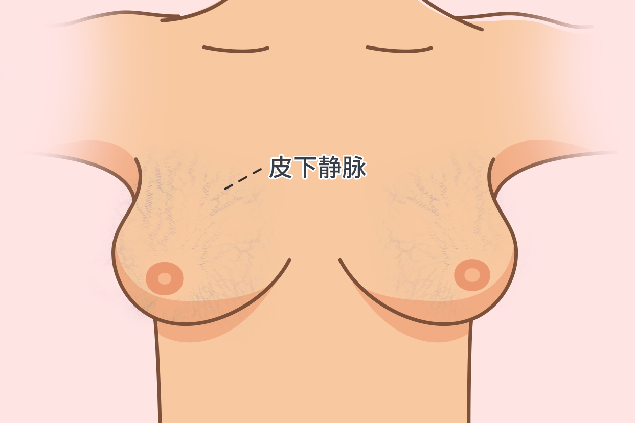 乳房皮下静脉图片 乳房皮下静脉炎