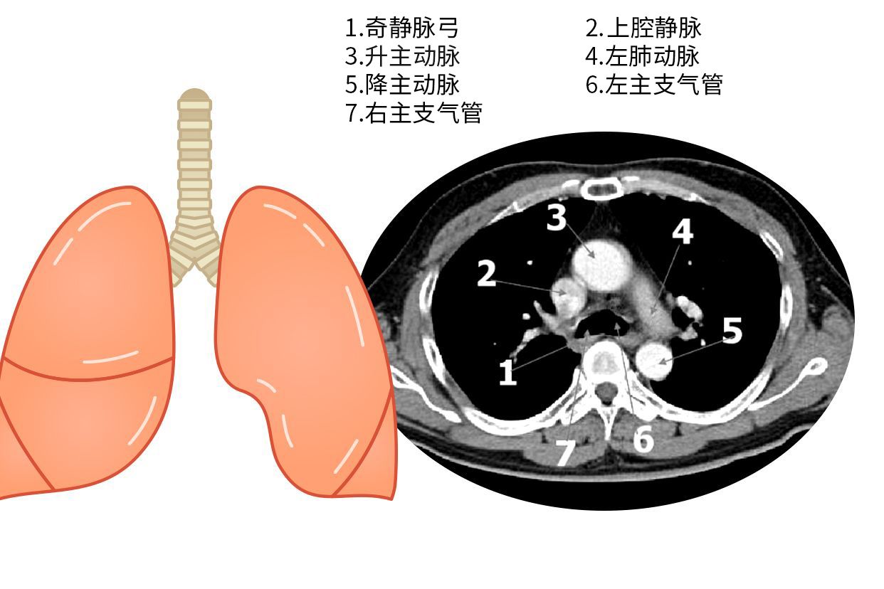 主动脉肺动脉窗图片 主动脉肺动脉窗的临床意义