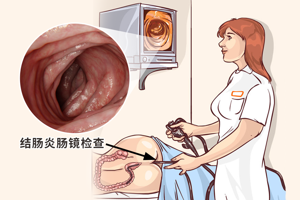 结肠炎肠镜检查图片 结肠炎肠镜检查图片高清