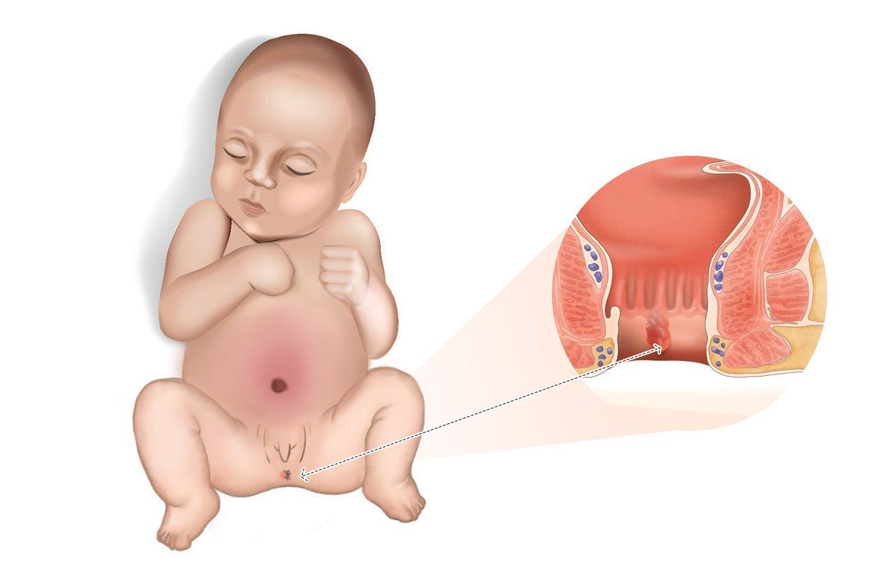 三个月婴儿肛门有肉疙瘩图片（三个月婴儿肛门有肉疙瘩图片怎么办）