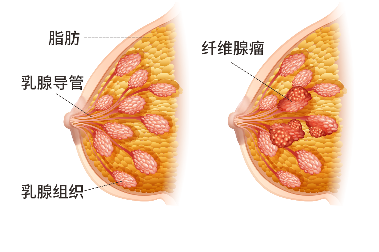 乳房上方纤维瘤图片 乳房上纤维瘤严重吗