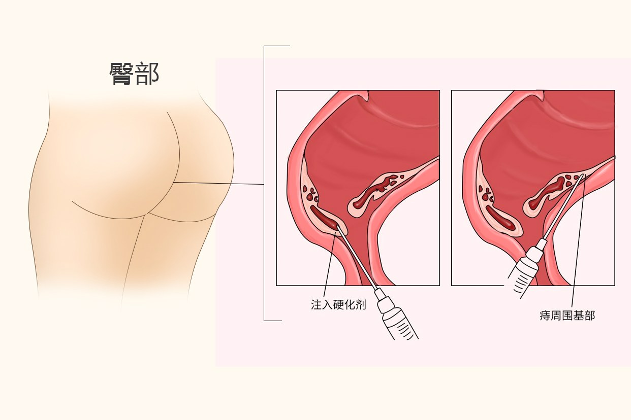 痔疮打针后一个星期后图片（痔疮打针后多长时间可以大便）