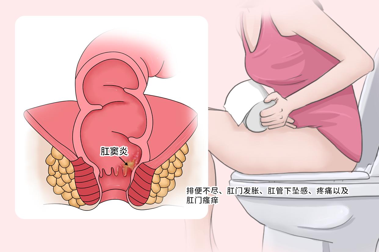 女性肛窦炎的症状图片 肛窦的位置肛窦炎图片