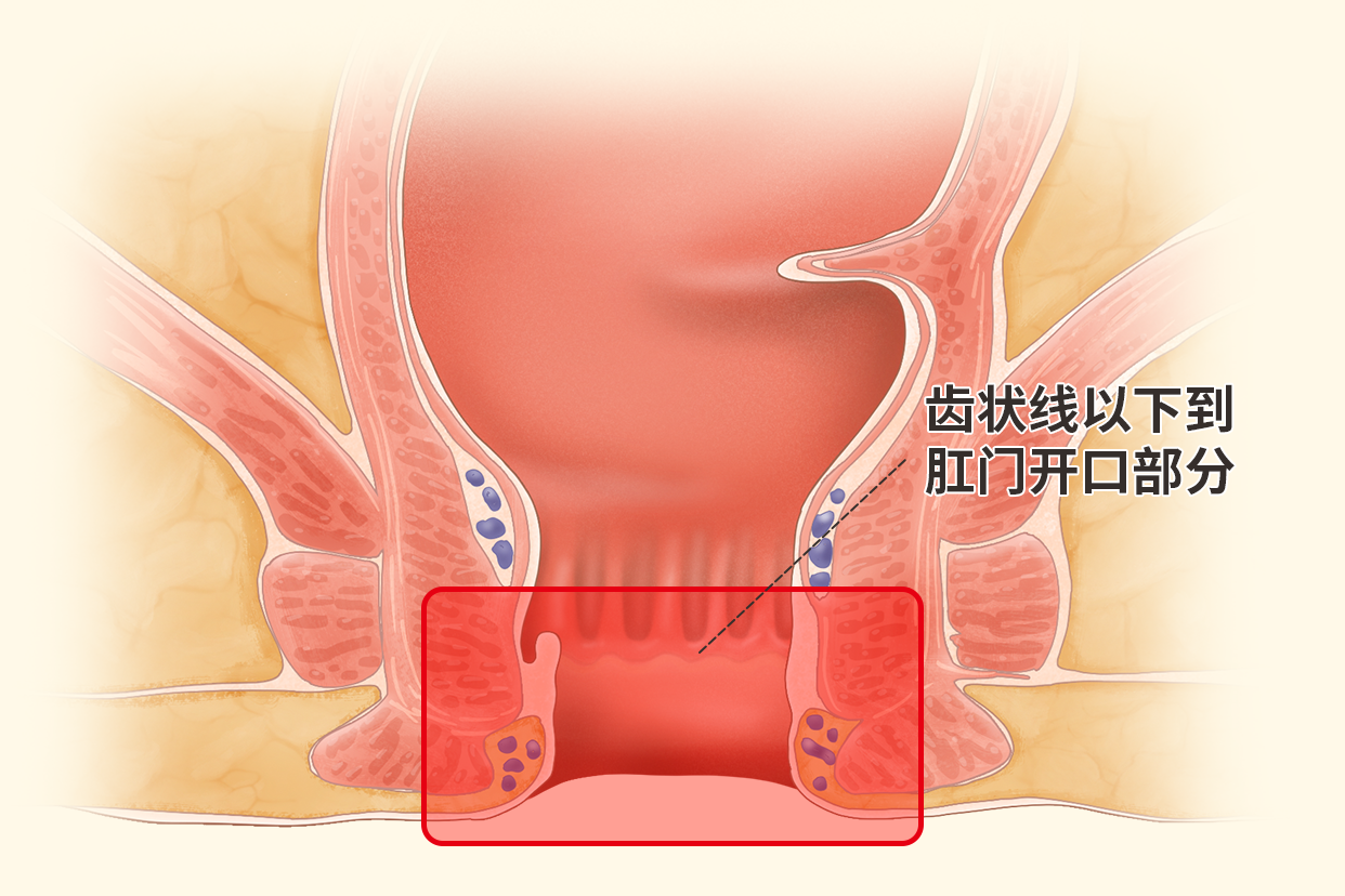 肛管癌位置图片 肛管癌症状图片