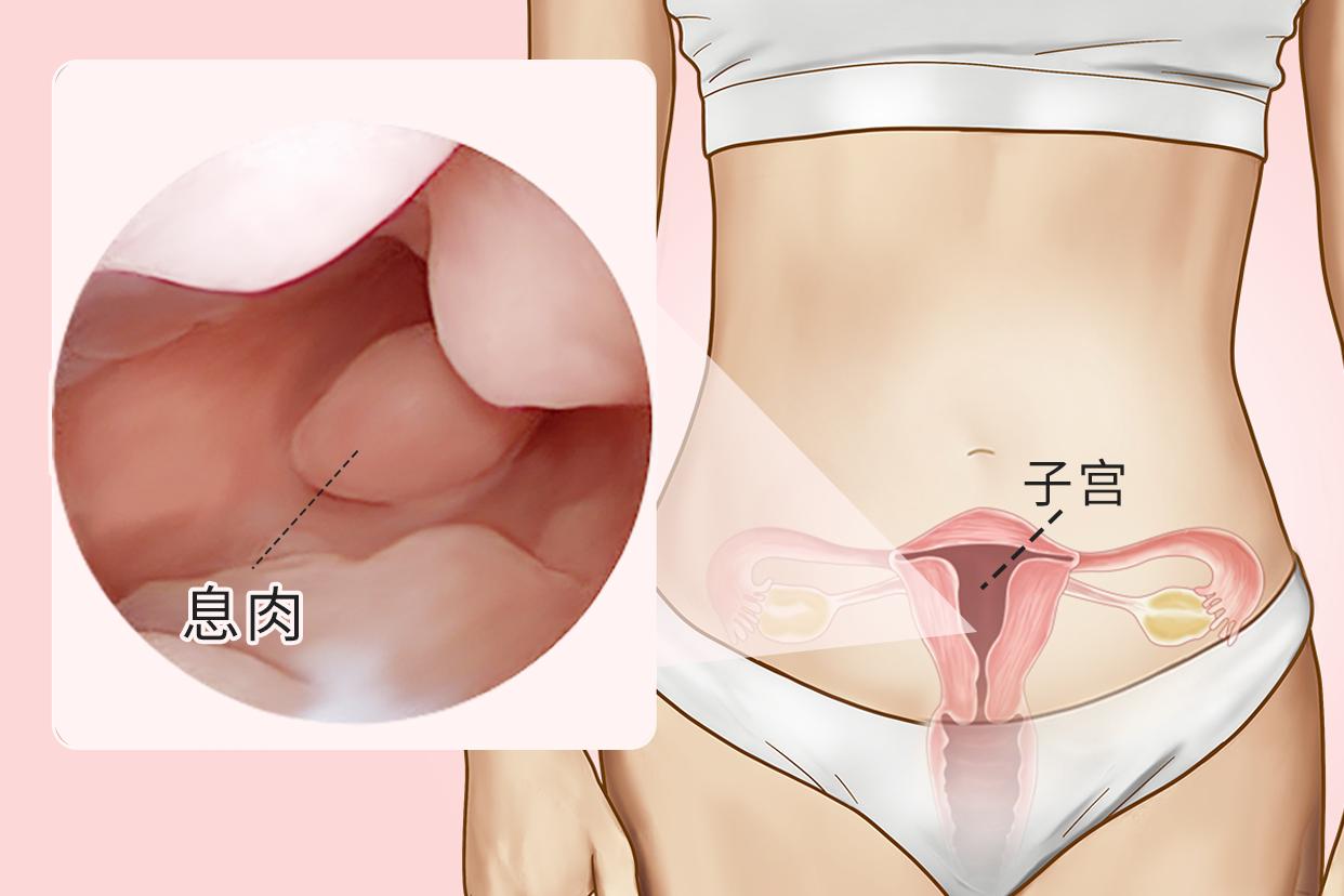 宫腔镜子宫内膜息肉良性图片 宫腔镜检查结果子宫内膜息肉