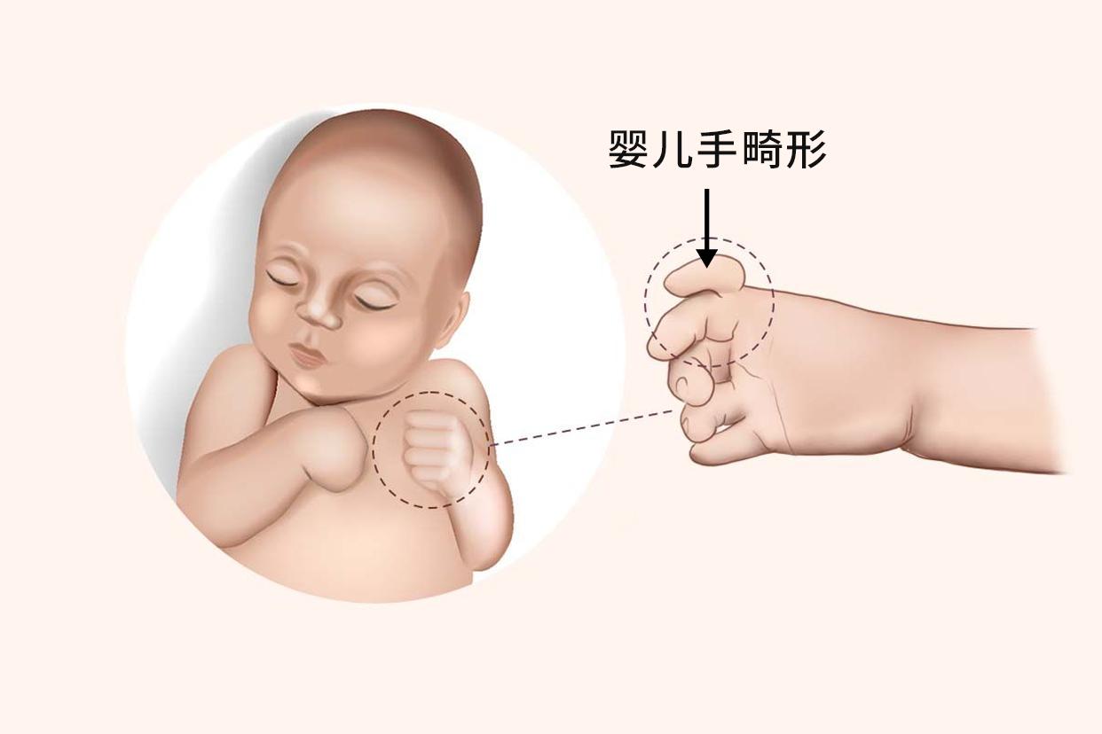 婴儿手畸形图片 婴儿手畸形怎么引起的