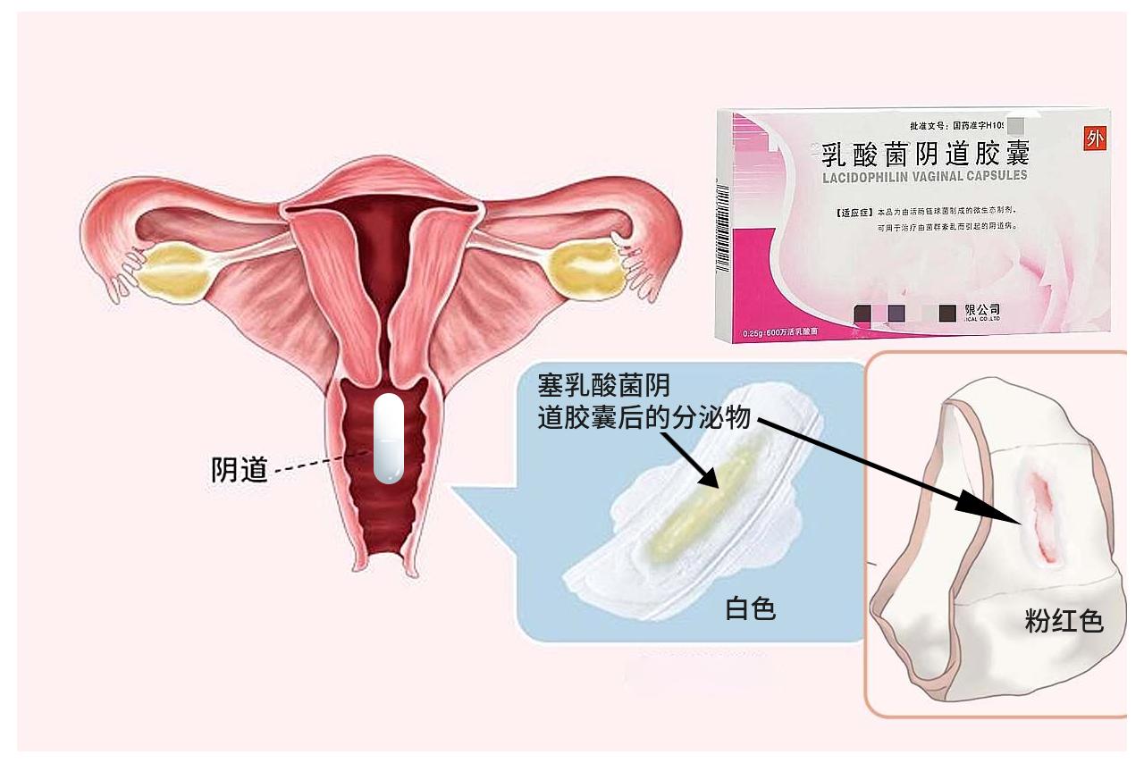 塞乳酸菌后的分泌物图片（塞乳酸菌后的分泌物图片大全）