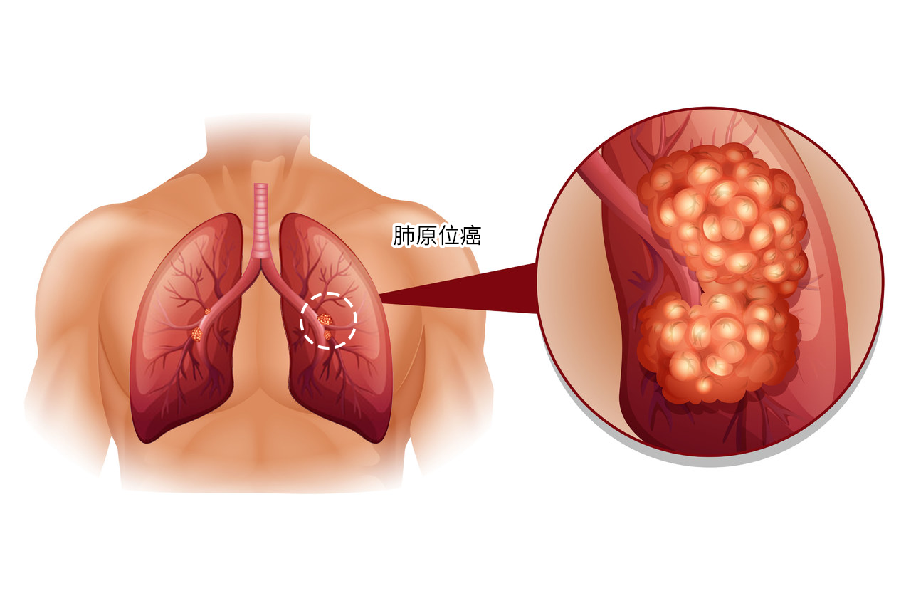 肺原位癌图（肺原位癌最新进展）