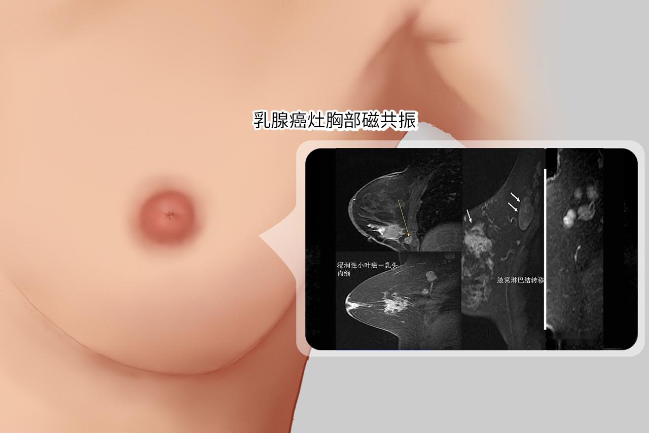 乳腺癌灶胸部磁共振图片 乳腺癌灶胸部磁共振图片
