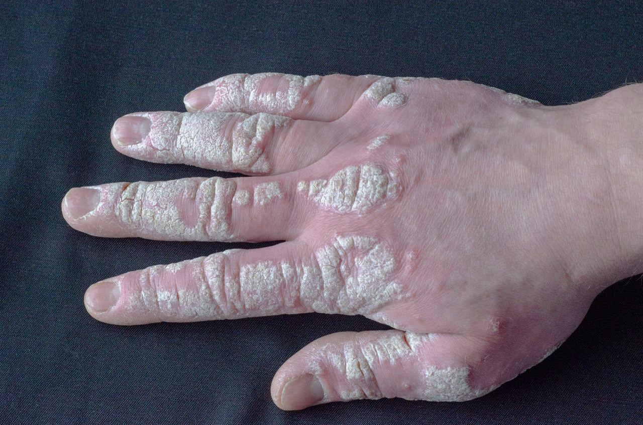 手指银屑病关节炎图片（手指银屑病关节炎图片大全）