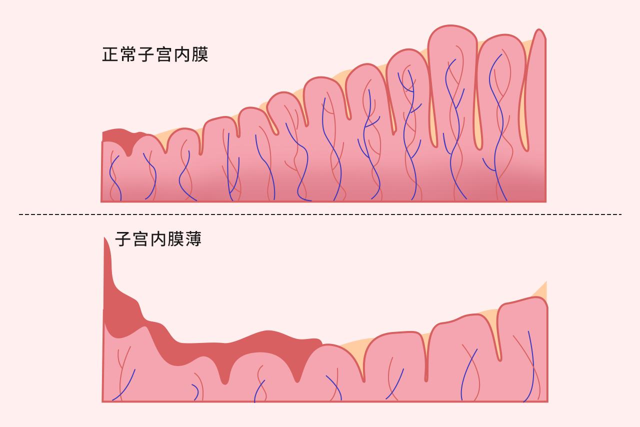 子宫内膜薄图片 子宫内膜薄的图片和正常的图片对比