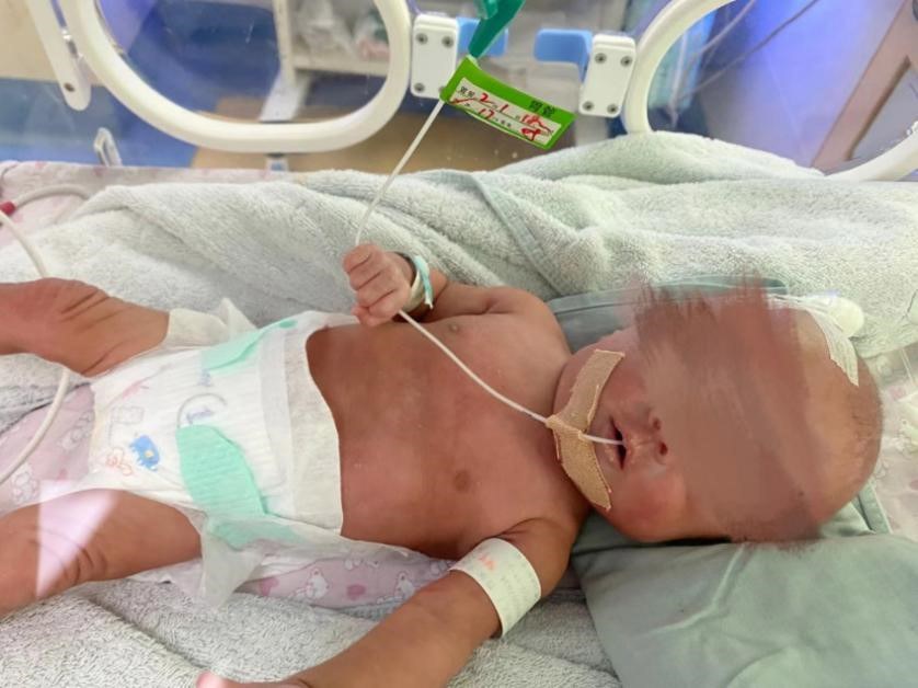 25周极早早产儿出生只有0.6公斤，医院全力救治令他活下来了