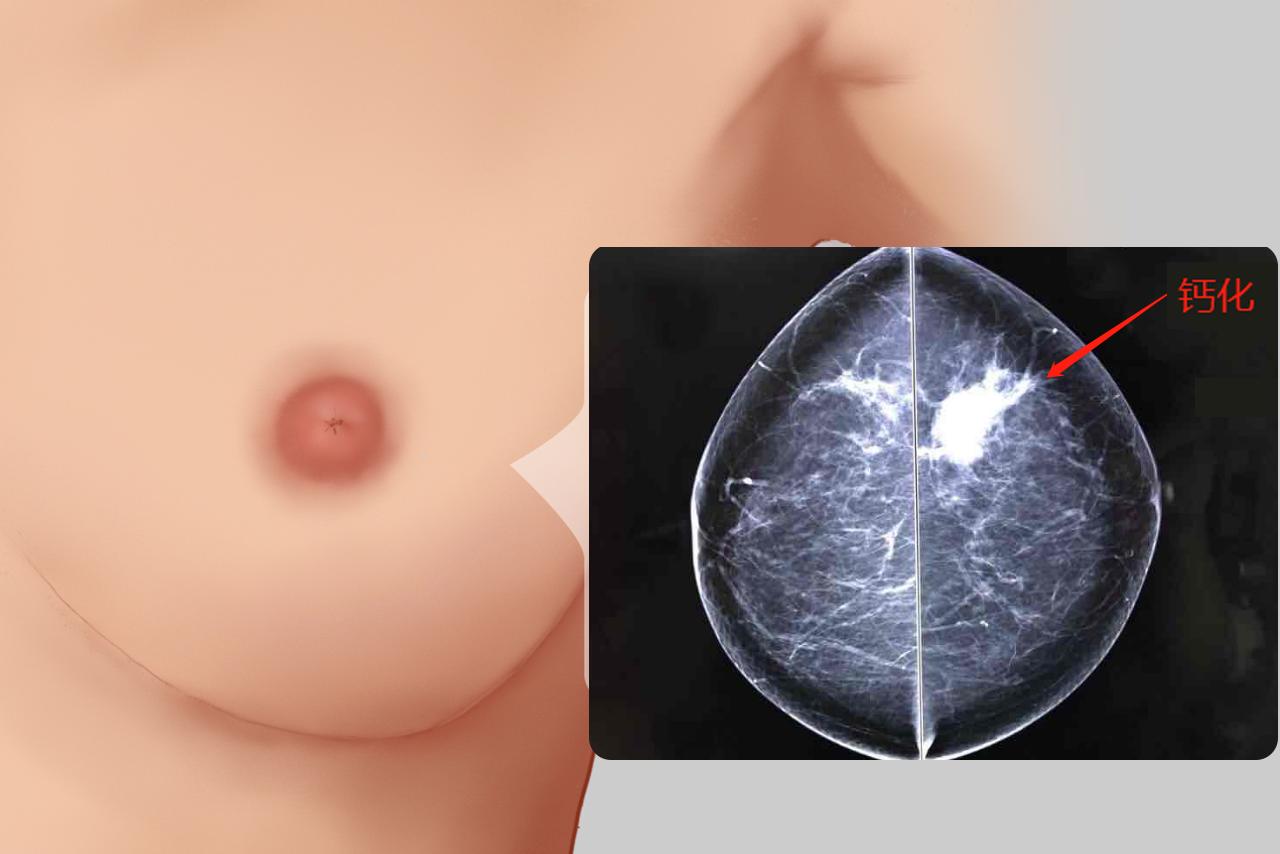 乳腺癌钙化图片 乳腺癌钙化图片大全