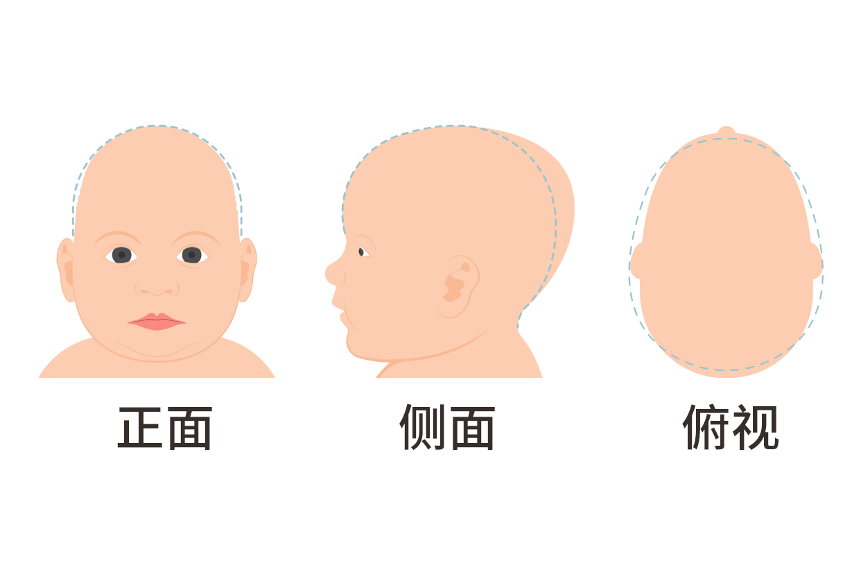 婴儿头两侧有凹陷怎么回事图片（婴儿头两侧有凹陷怎么回事图片）