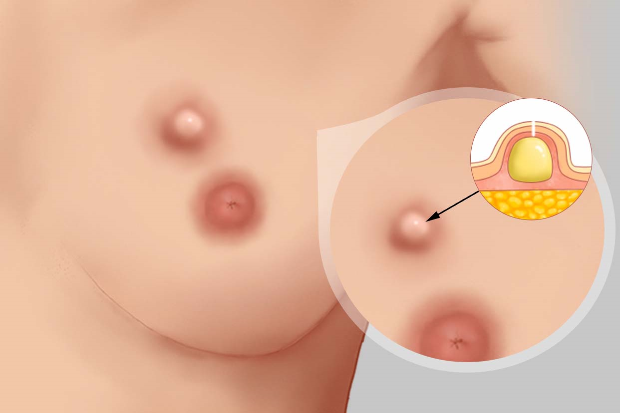 乳腺脓包图片 乳腺脓包能自愈