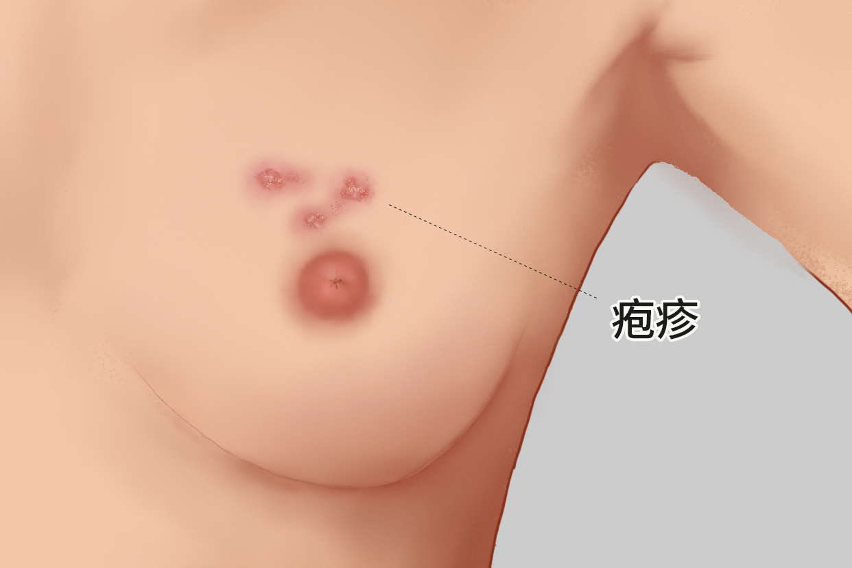 女性乳房长疱疹图样 女人乳房上长疱疹是什么样的