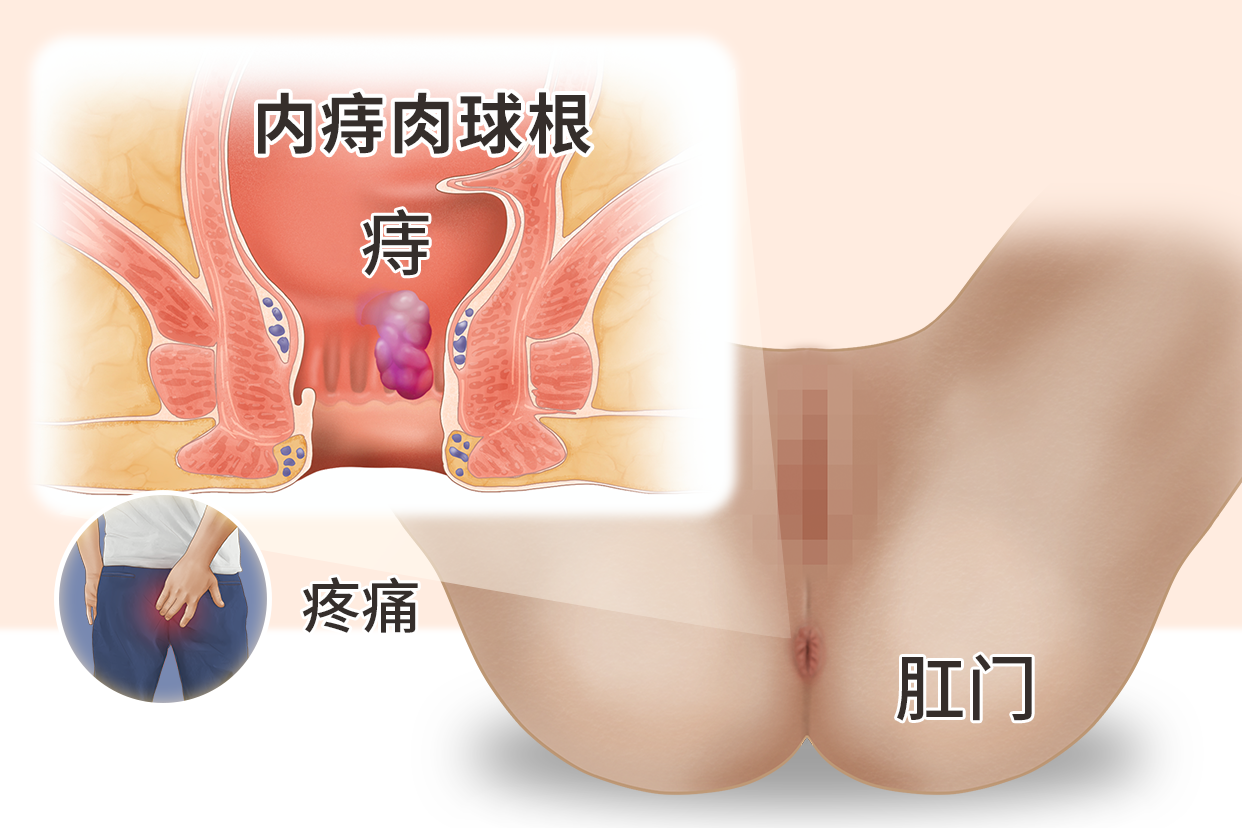 痔疮肉球有根筋疼是肉球根吗图片 痔疮肉球根部疼