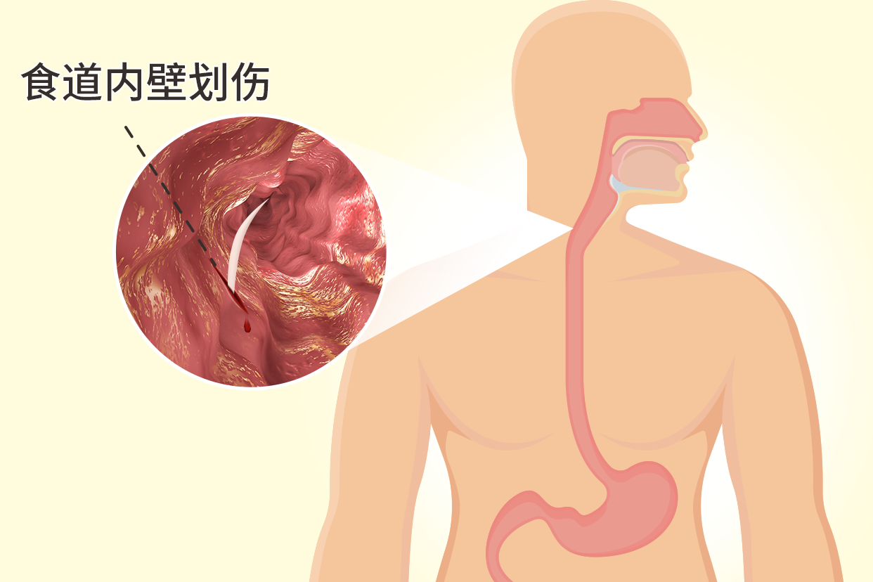 食道划伤图片