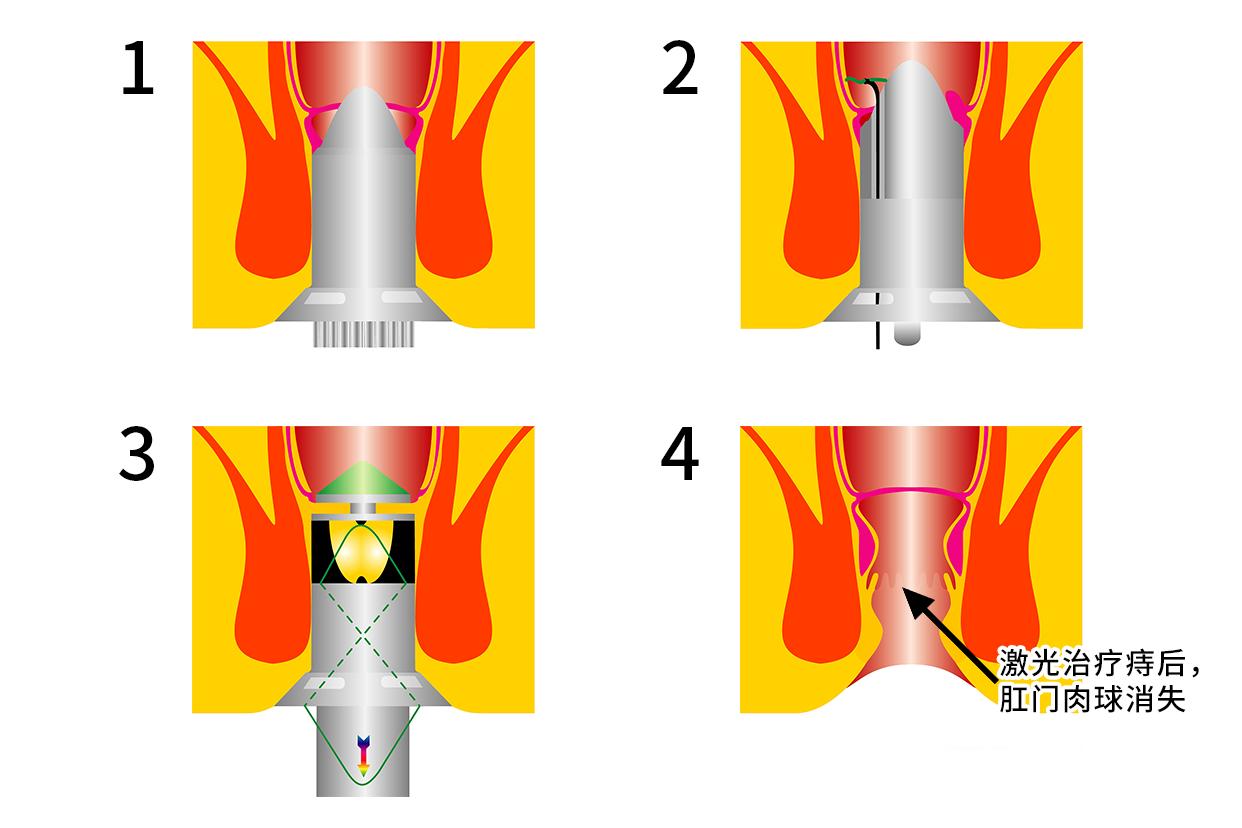 痔疮激光术后肛门口肉球图